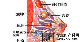 乳腺脂肪瘤是什么原因引起的